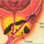 prostate_2