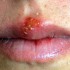 herpes herpes